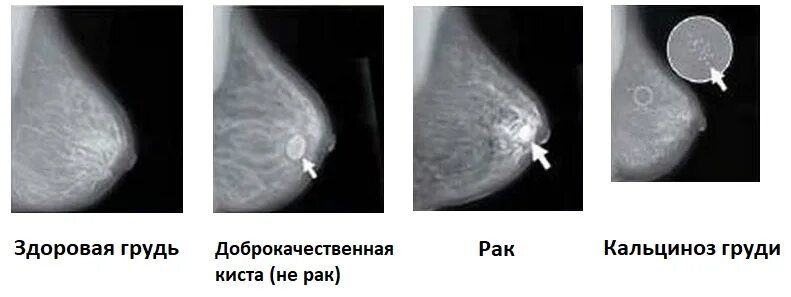 Рак груди1 стадии фото у женщин Рентген молочных желез: показывает ли маммография рак, затемнения на снимке afro