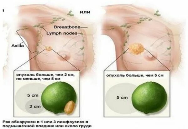 Рак груди1 стадии как распознать фото Рак молочной железы 2 степени: продолжительность жизни, лечение