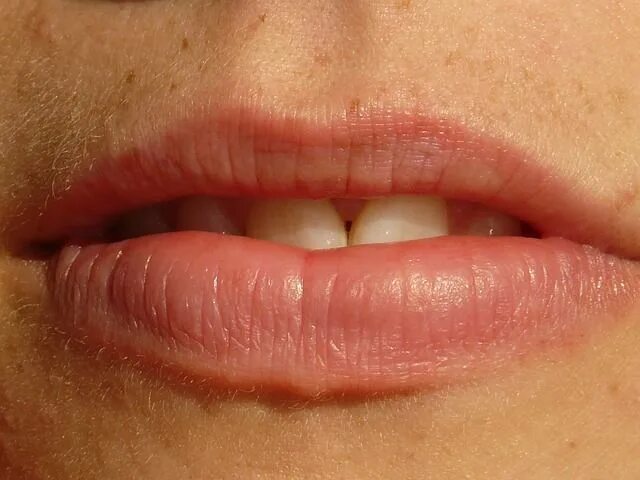 Рак губы 1 стадия фото 10 Ways to Quickly Get Rid of Cracked, Dry Lips Sjogrens syndrome, Sjogrens, Bad