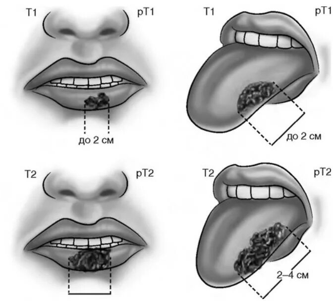 Рак губы ранняя стадия фото Причины и факторы риска онкологии рта - злокачественные опухоли полости рта Нова