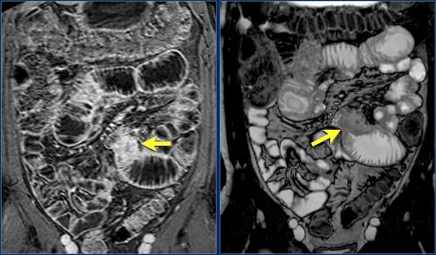 Рак кишечника стадии фото The Radiology Assistant : Small Bowel Tumors