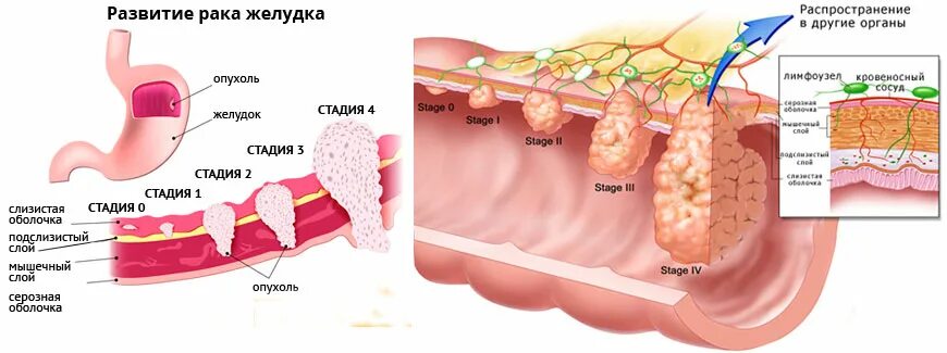 Рак кишечника стадии фото Ранняя диагностика рака - НИИ хирургии и неотложной медицины ПСПБГМУ им. акад. И