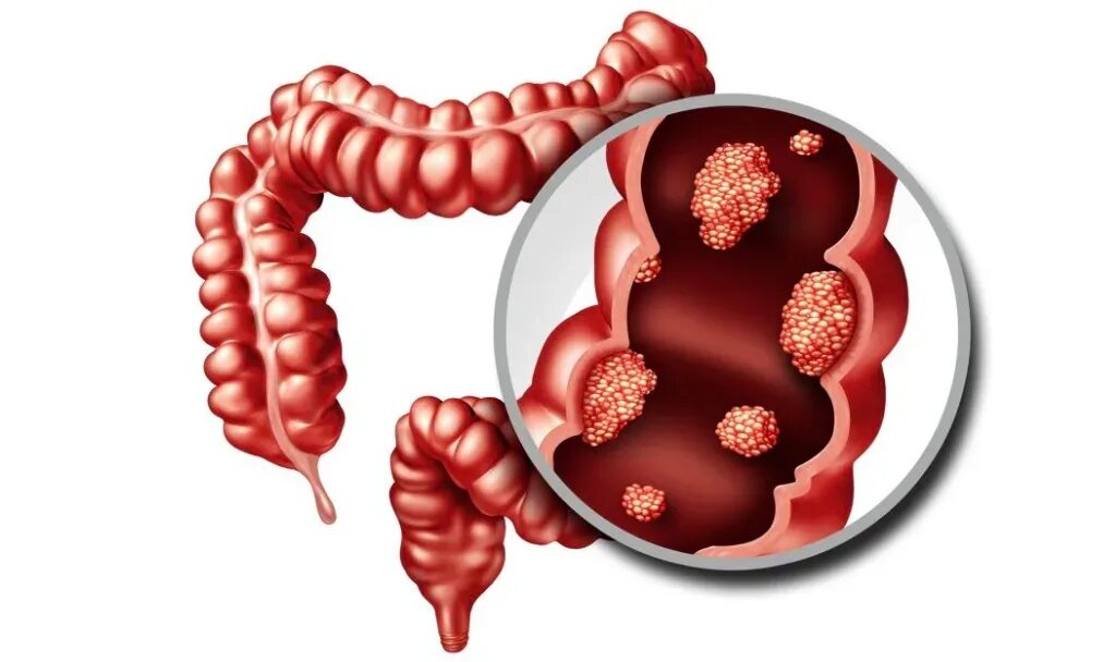 Рак кишечника стадии фото Лечение рака толстой кишки в клинике OncoCareClinic 308