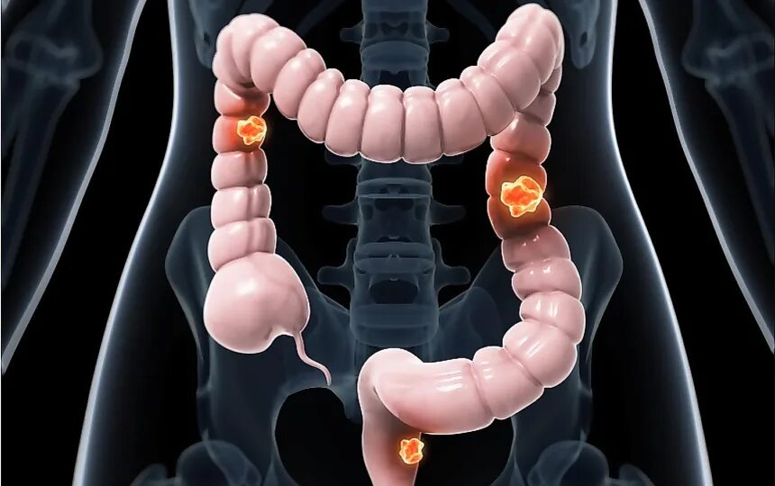 Рак кишечника стадии фото Колоректальный рак. Что важно знать