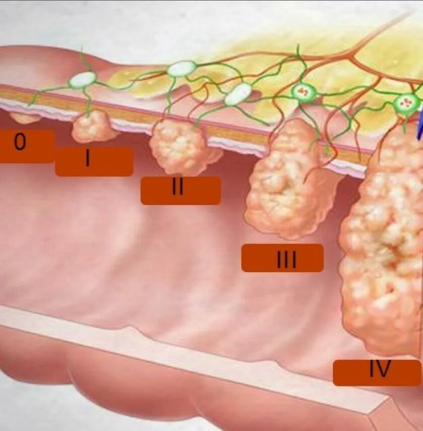 Рак кишечника стадии фото Аденокарцинома легкого - симптомы, диагностика, стадии болезни и виды аденокарци