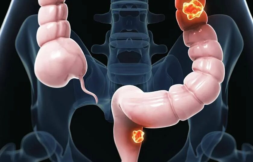 Рак кишечника стадии фото Cтадии рака кишечника, прогноз рака кишки с метастазами 4 стадии