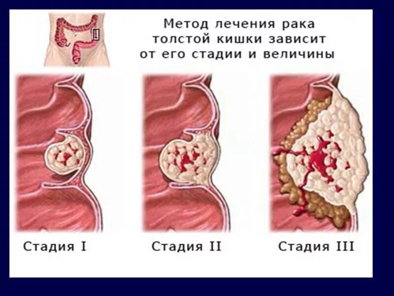 Рак кишечника стадии фото Рак толстой кишки