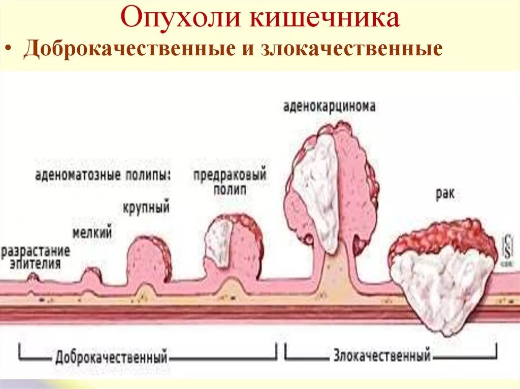 Рак кишечника стадии фото Рак тонкого кишечника: симптомы и проявление заболевания