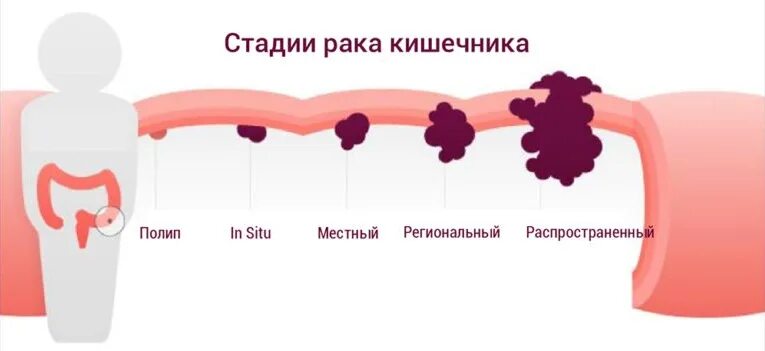 Рак кишечника стадии фото Рак кишечника: причины, симптомы и лечение в Москве в ФНКЦ ФМБА России