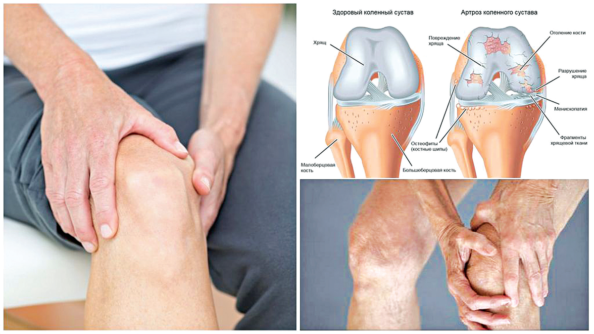 Рак коленного сустава симптомы фото Можно греть суставы при артрозе коленного сустава - найдено 90 картинок