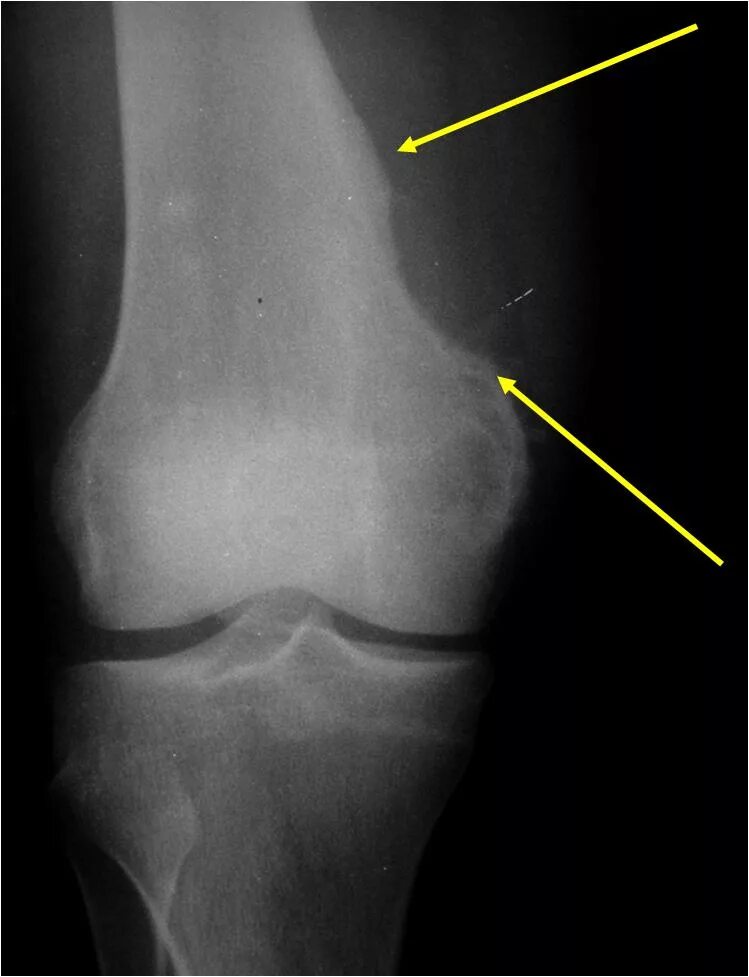 Рак коленного сустава симптомы фото Juxtacortical (Periosteal) Chondrosarcoma : Bone Tumor Cancer