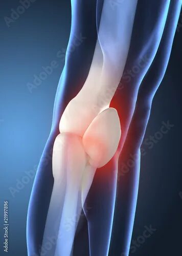 Рак коленного сустава симптомы фото Painful human knee concept Иллюстрация Stock Adobe Stock