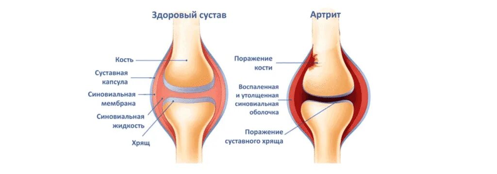 Рак коленного сустава симптомы фото ▶ Лечение боли в колене в Полтаве - OrtoSano Полтава