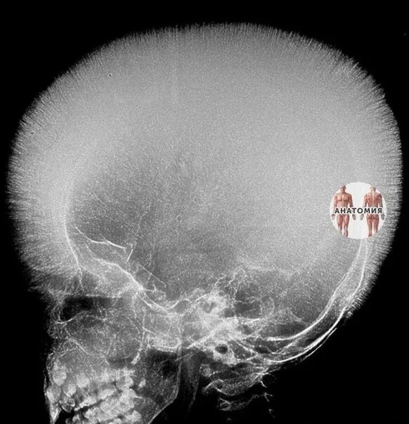 Рак костей черепа фото человека The phenomenon of "hairy skull" or needle periostosis in thalassemia 2022 Анатом