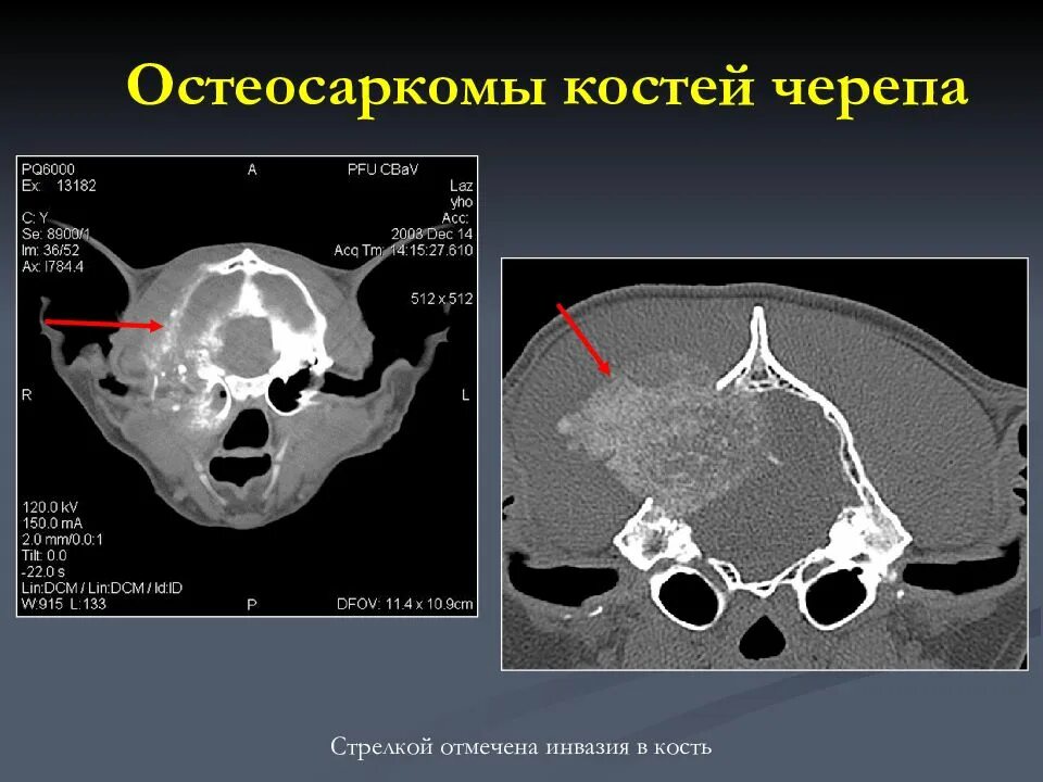 Рак костей черепа фото человека Кт скелета