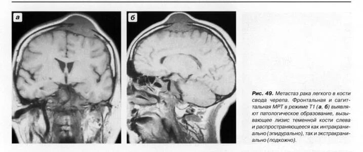 Рак костей черепа симптомы фото Поражение костей свода черепа Портал радиологов