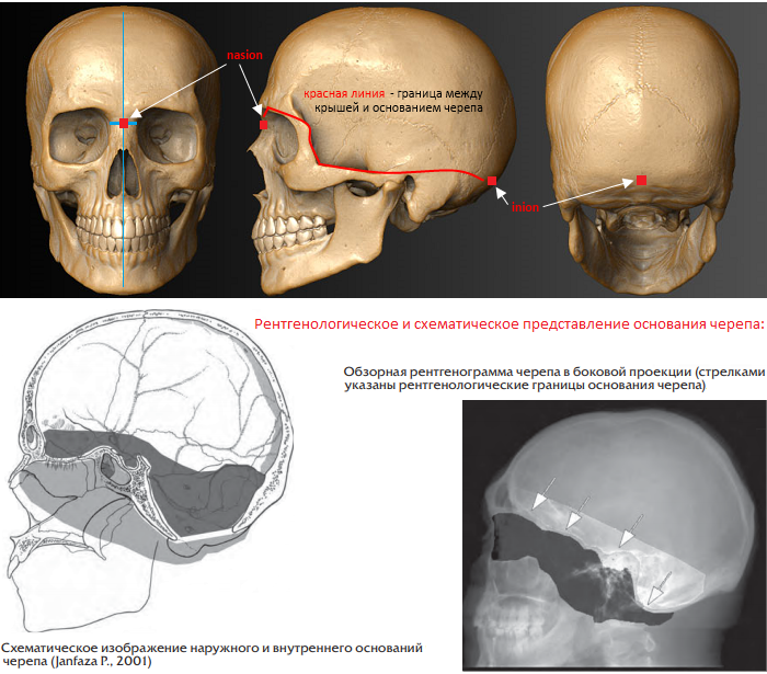 Рак костей черепа симптомы фото Картинки ГРАНИЦЫ МЕЖДУ СВОДА ЧЕРЕПА