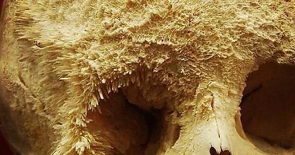 Рак костей фото больных Bone Cancer Enveloping a Human Skull - Album on Imgur