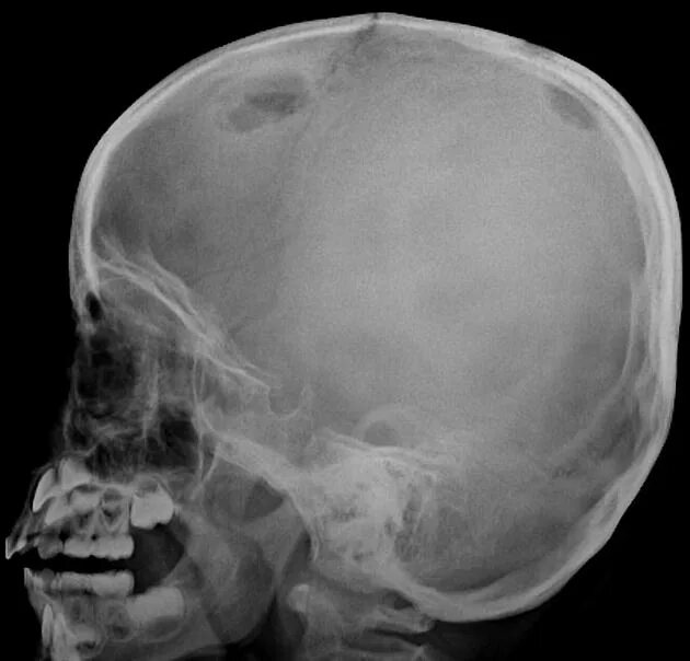 Рак костей фото черепа Langerhans cell histiocytosis: skeletal manifestations Radiology Reference Artic