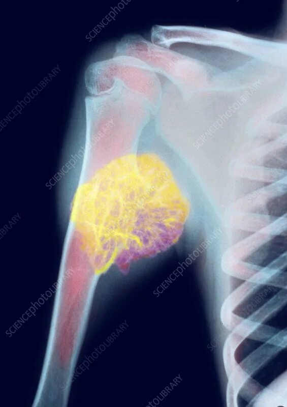 Рак костей фото на человеке Bone tumour, X-ray - Stock Image - M134/0445 - Science Photo Library