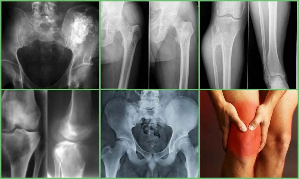 Рак костей фото на человеке Рак кости сустава: найдено 85 изображений