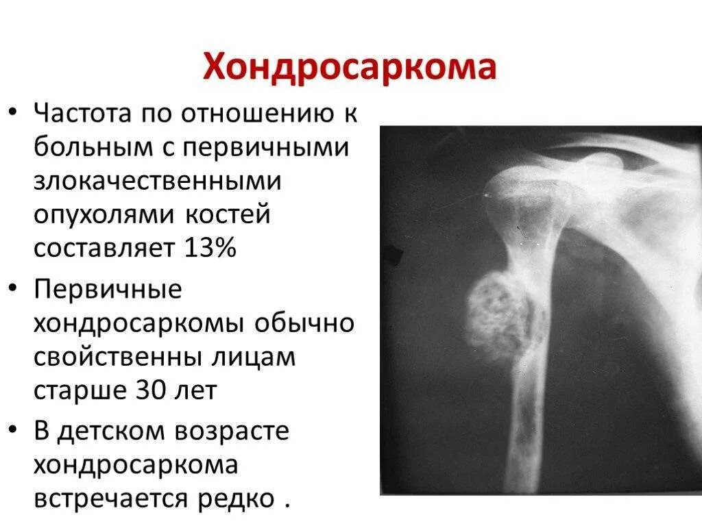 Рак костей симптомы фото Редкие злокачественные опухоли костей