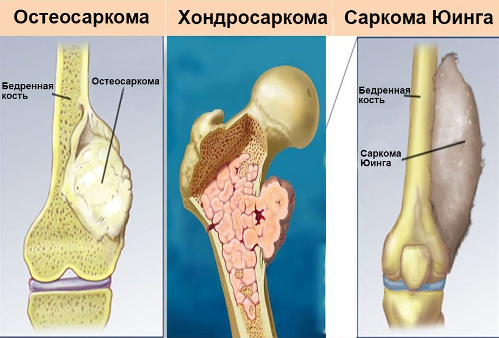 Рак костей симптомы фото Редкий, но опасный вид рака: что такое саркома и где она может возникать О здоро