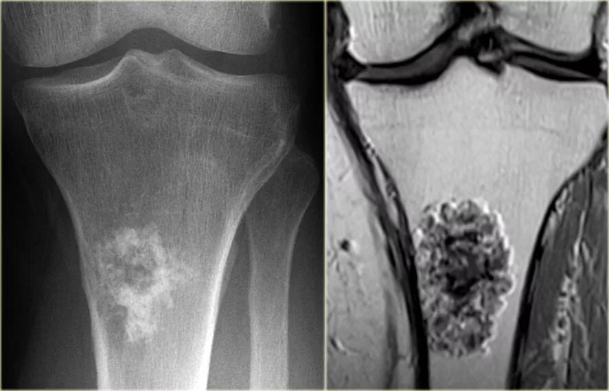 Рак кости фото начальная стадия The Radiology Assistant : Bone tumor A-G