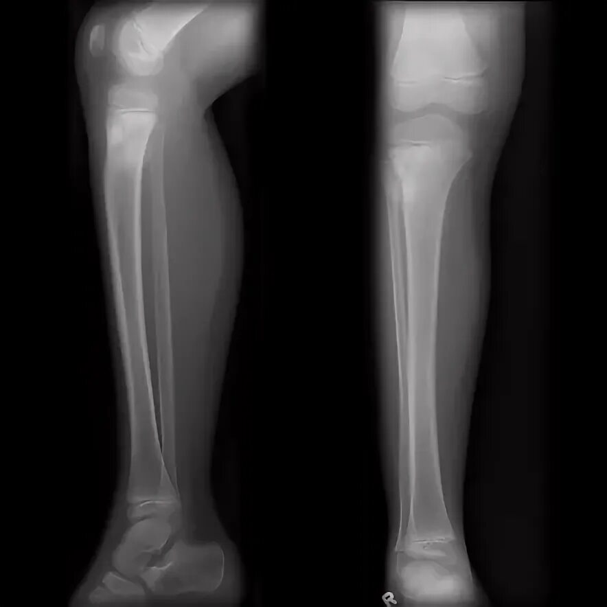 Рак кости ноги симптомы фото Osteosarcoma - tibia Radiology Case Radiopaedia.org