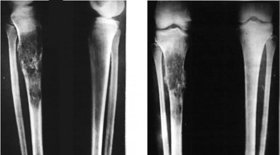 Рак кости ноги симптомы фото Рак костей симптомы метастазы