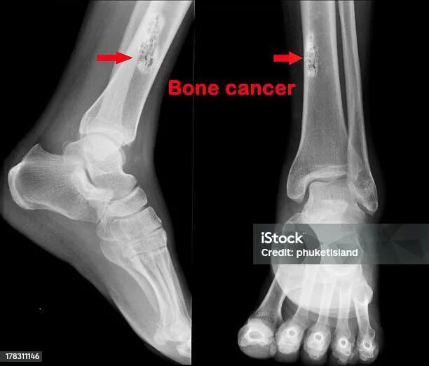 Рак кости ноги симптомы фото Кость Рак - стоковые фотографии и другие картинки Горизонтальный - Горизонтальны