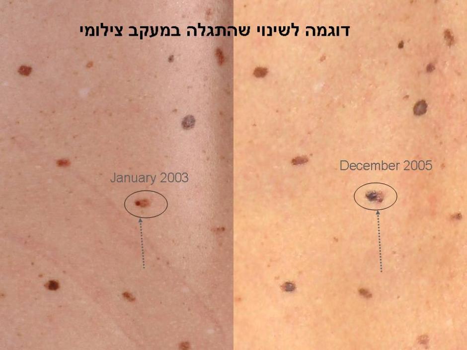 Рак кожи 1 стадия фото Клиника ранней диагностики меланомы Лечение в Израиле