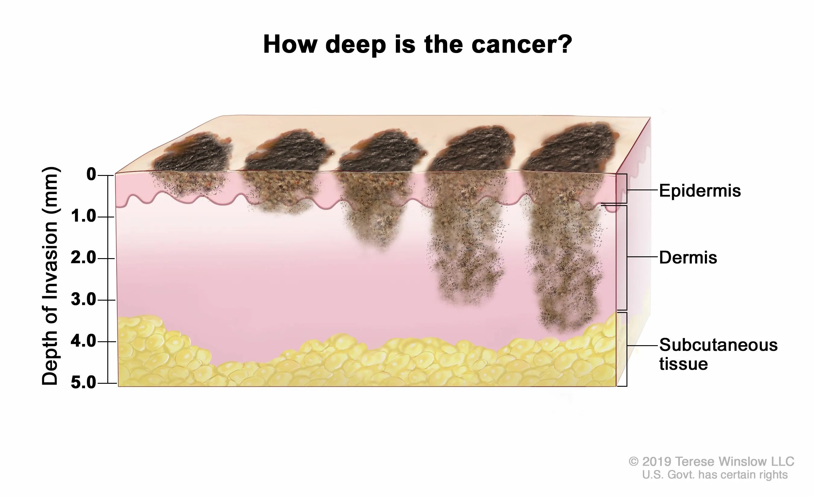 Рак кожи 3 стадия фото Melanoma Treatment - NCI