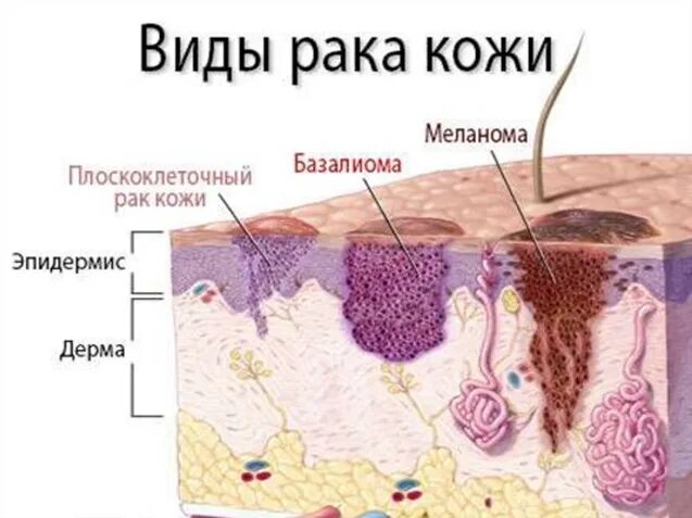 Рак кожи 3 стадия фото Рак кожи: базалиома, плоскоклеточная карцинома и меланома, лечение в Москве в ФН