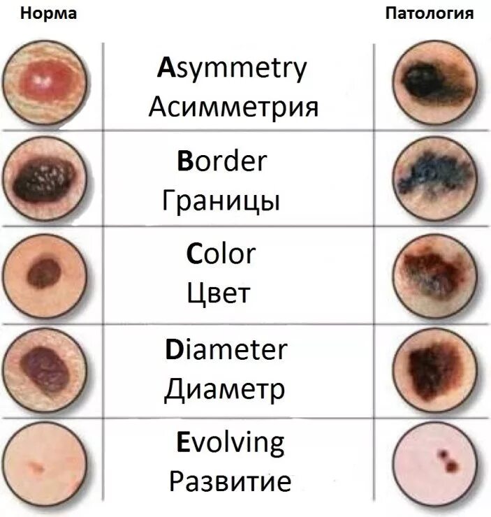 Рак кожи 3 стадия фото Обследуйте родинки - сохраните свою жизнь! - Онкологический центр имени Н.П. Нап