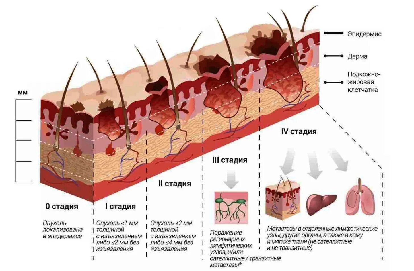 Рак кожи 4 стадия фото Лечение и диагностика новообразований кожи - Медицинский центр "Мирт" в Москве