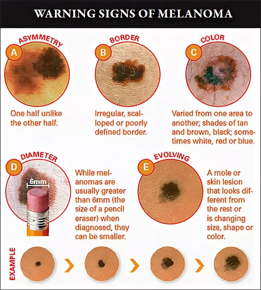 Рак кожи фото симптомы Warning Signs of Melanoma - ABCDEs