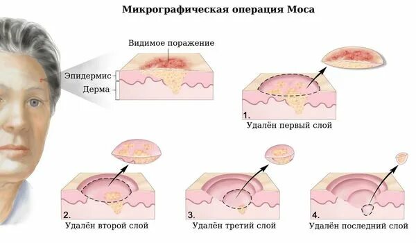 Рак кожи лица признаки симптомы фото Базалиома (базальноклеточный рак): причины, симптомы и лечение в статье онколога