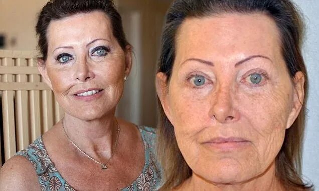 Рак кожи на лице фото у женщин My face was wrecked by skin cancer... but my plastic surgeon left me looking 10 