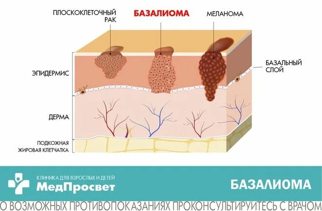 Рак кожи начальная стадия фото базалиома Виктор Рыбин и Наталья Сенчукова больны раком-это правда?