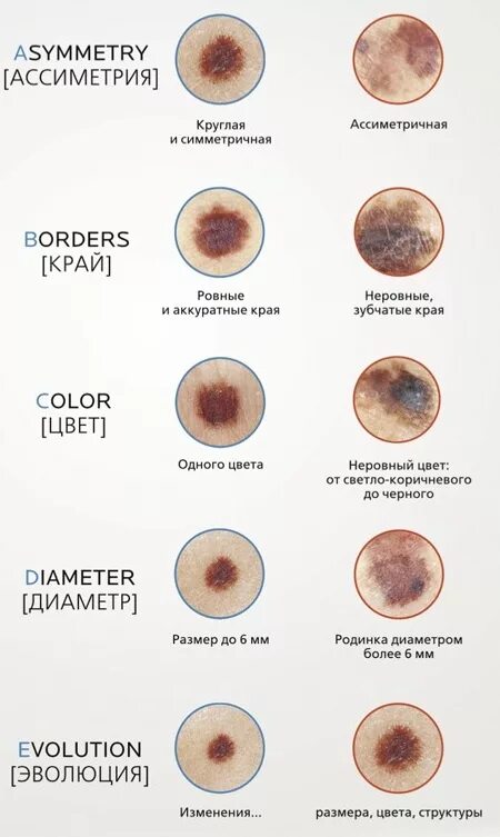 Рак кожи начальная стадия фото как выглядит Доброкачественные и злокачественные невусы: тревожные признаки больших родинок -