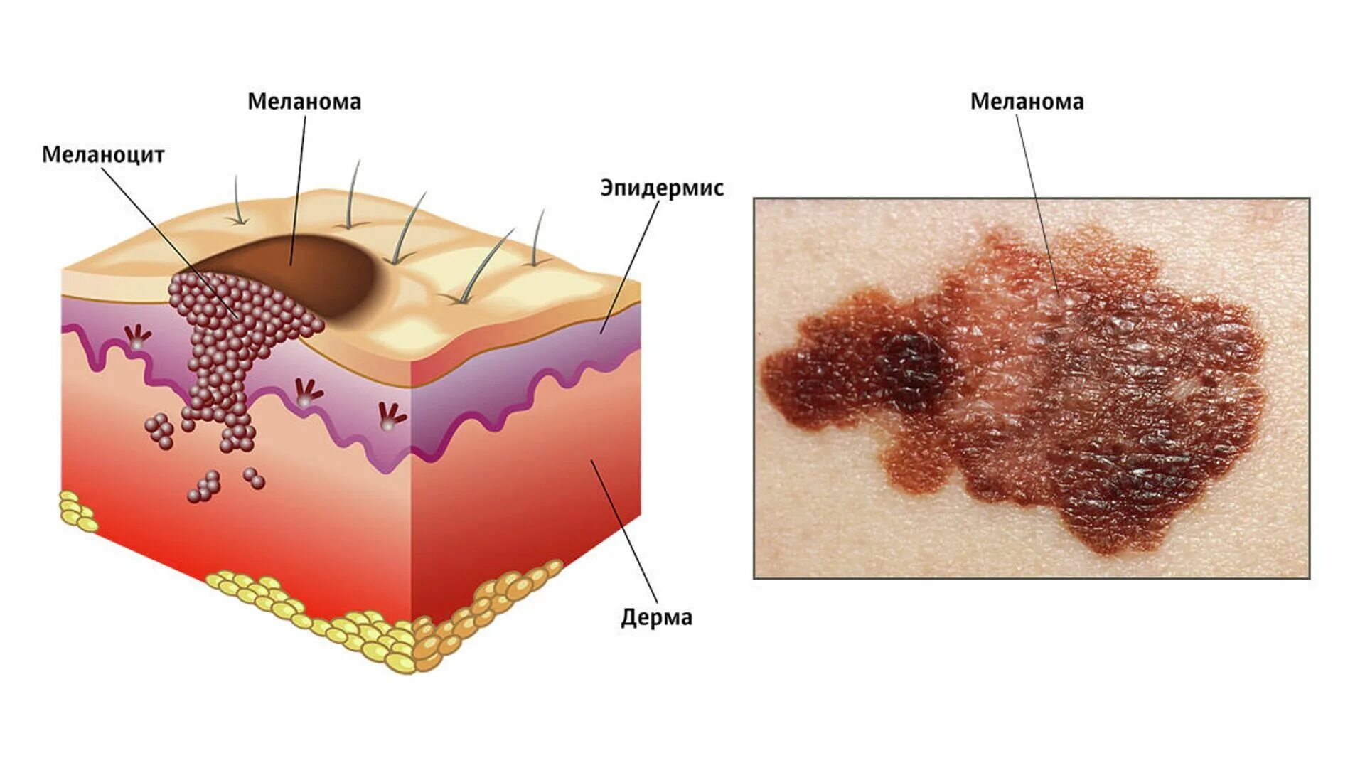 Рак кожи начальная стадия фото меланома В России знают, как использовать искусственный интеллект в борьбе с раком - РИА 