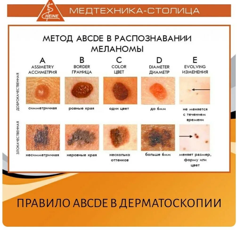 Рак кожи начальная стадия фото меланома Как нарисовать родинки