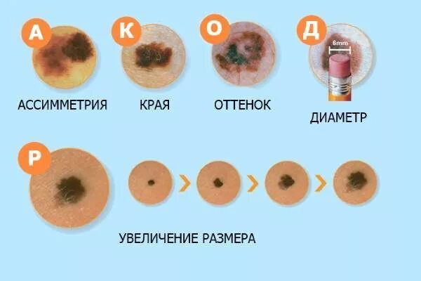 Рак кожи признаки фото как выглядит Родинка или опухоль? - Поликлиника Сканер