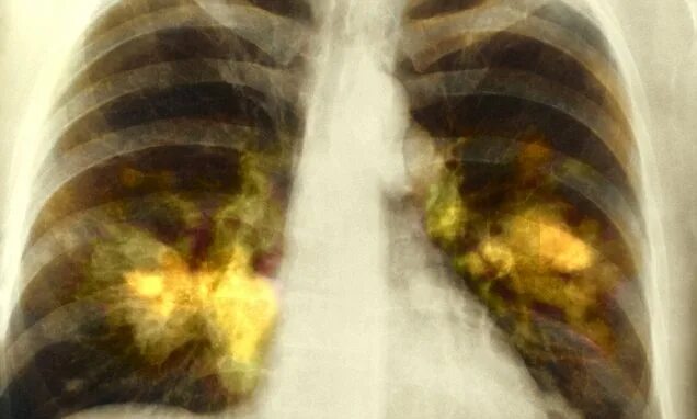 Рак легких 4 стадия фото Lung cancer drug could stop the deadly disease from spreading in breakthrough