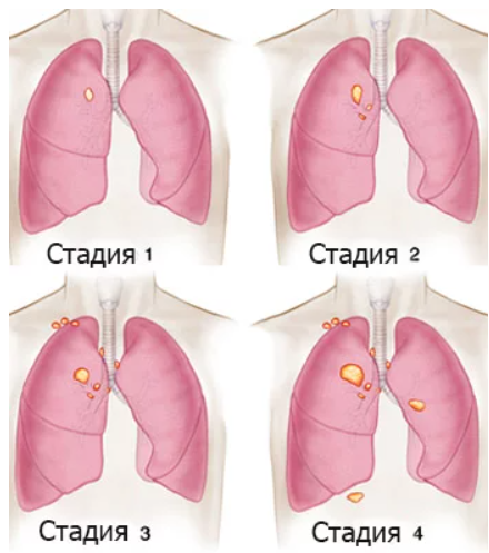 Рак легких 4 стадия фото Неделя профилактики рака легких (26.06.2023 -02.07.2023г.