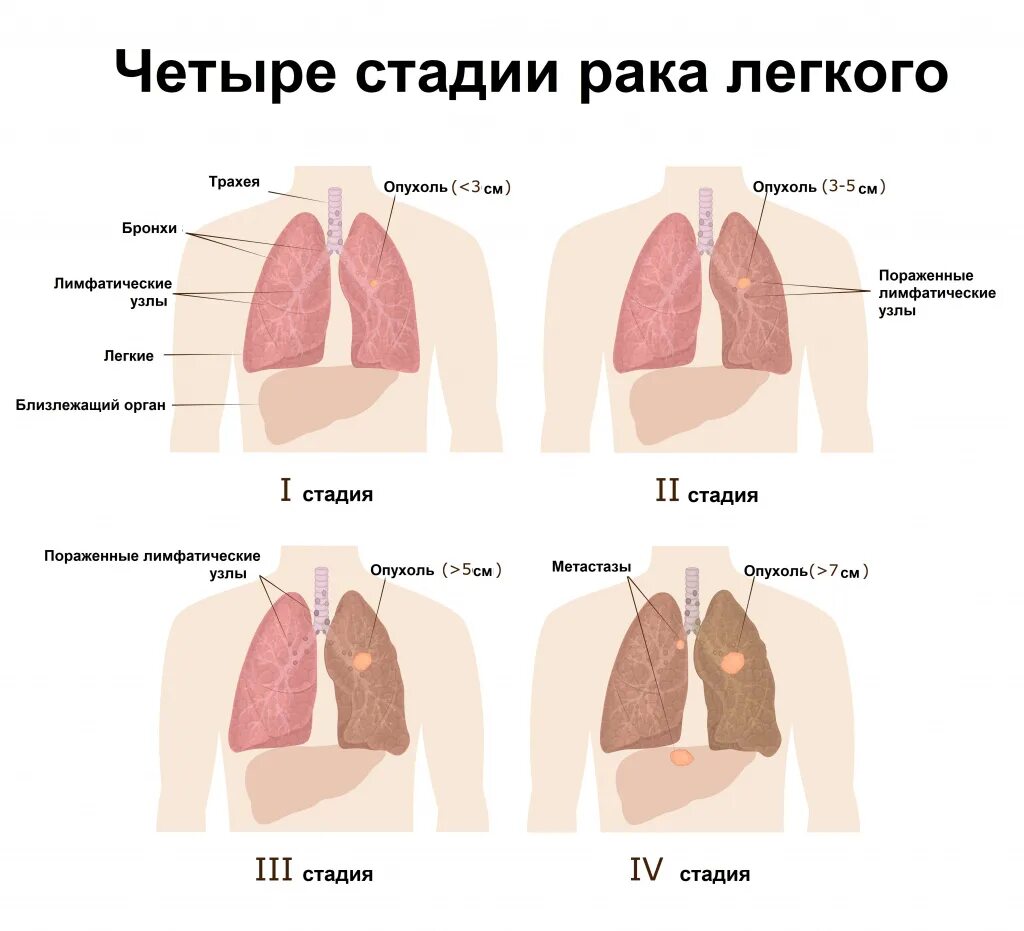 Рак легких 4 стадия фото Рак легкого - причины появления, симптомы заболевания, диагностика и способы леч