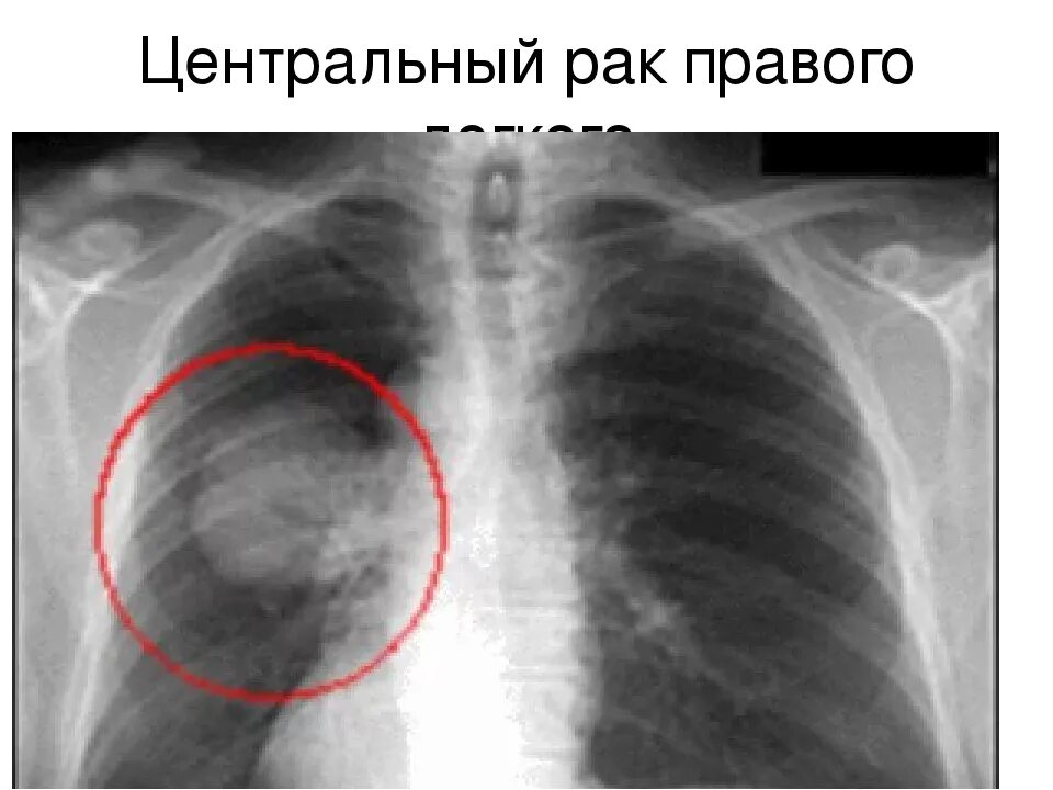 Рак легких 4 стадия фото Рентген показывает метастазы