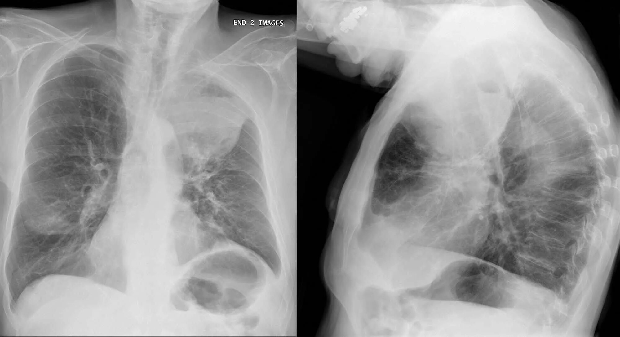 Рак легких симптомы фото Adjuvant Osimertinib: A New Standard in EGFR-Mutant NSCLC- Cancer Therapy Adviso