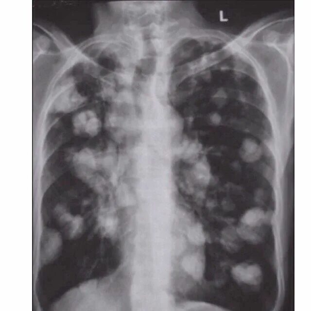 Рак легких симптомы фото Mosaiced on Instagram: "what's the cause of cannonball mets? #medstudent #foamed